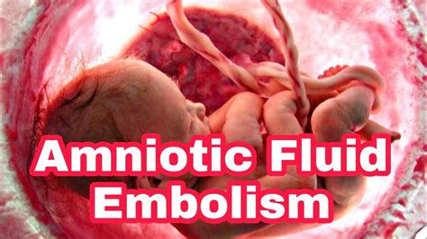 straw colored amniotic fluid|Amniotic Fluid: Development, Functions, Complications